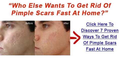 get rid of acne scars on your face how to get rid of pimple scars