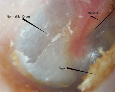 ear wax images mcgovern medical school