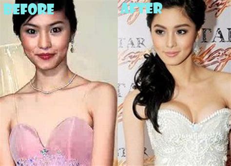 kim chiu plastic surgery before and after nose job breast implant