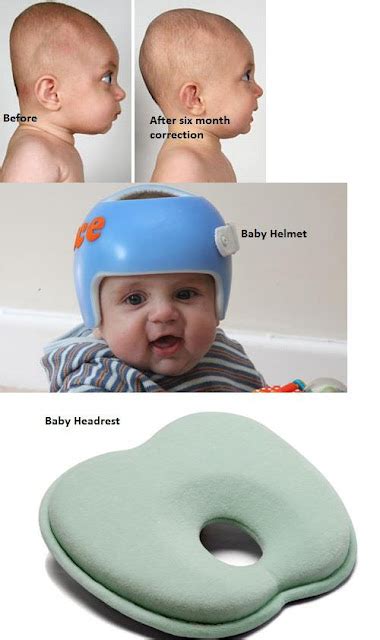 Amazing Stories Around The World Plagiocephaly Its Abnormality Of