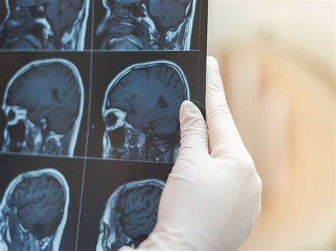 guz mozgu objawy rodzaje  rozpoznanie raka mozgu zdrowie wprost