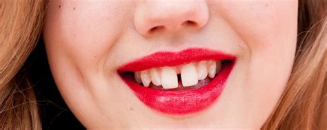 l écart entre l avant et les autres dents comment réparer et enlever