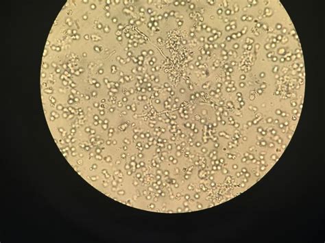 yeast   urine sediment microscopy unspunkidney failure ml urine   daysfacebook page