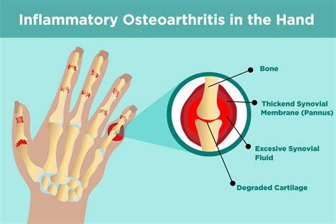 understanding erosive osteoarthritis  symptoms treatment