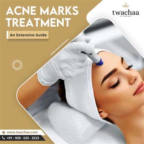 extensive guide    acne marks treatment