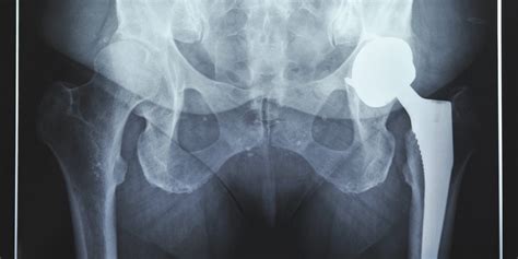 exercise could lessen need for hip replacement huffpost