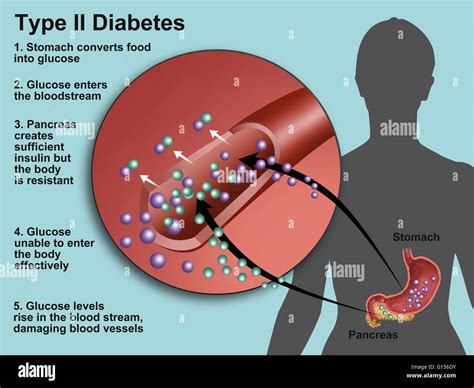 llustration  insulin  glucose production  type  diabetes stock