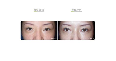 epicanthoplasty lateral before after 06 知美整形外科診所