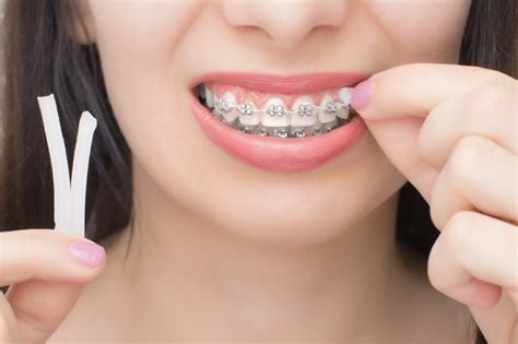 What Is Braces Wax For Its Uses And Frequently Asked Questions