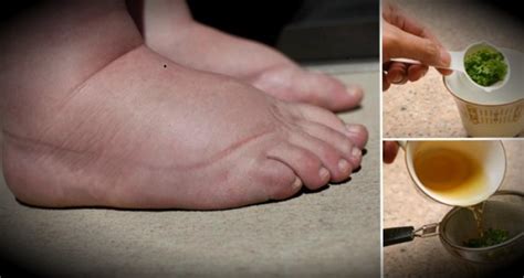 This Fluid Retention In Feet Treatment Will Solve Your