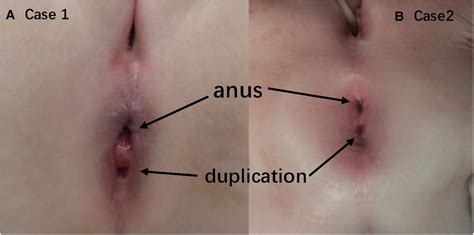 Frontiers Case Report Anal Canal Duplication Associated With