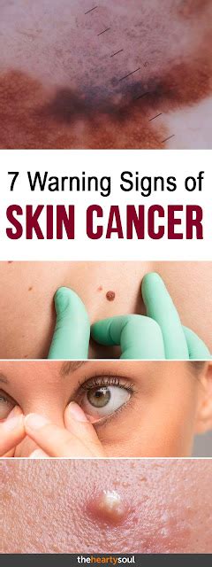 7 Skin Cancer Warning Signs You Should Never Ignore Wellness Days