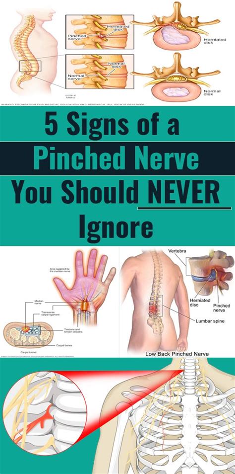 Signs Of A Pinched Nerve You Shouldn’t Ignore Pinched Nerve Nerve