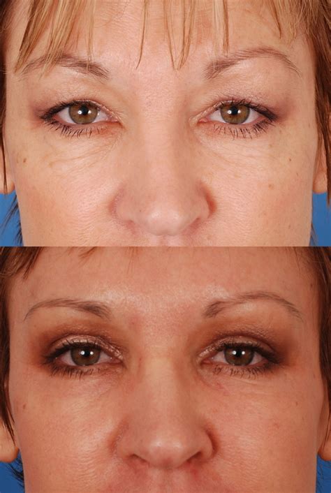 eyelid surgery    dr bassichis