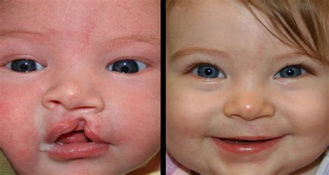 info  cleft lip  cleft palate repair surgery