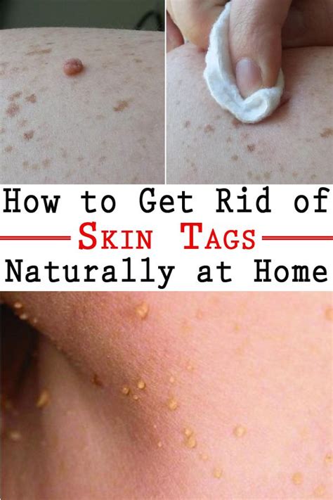 how to get rid of skin tags naturally at home health and body skin tag removal skin tag warts