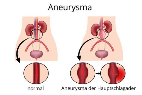 aneurysma formen symptome behandlung