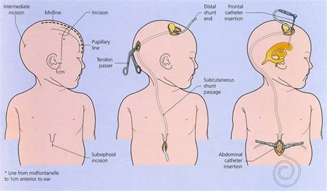 Ventriculoperitoneal Shunts Pediatrics Clerkship The University Of