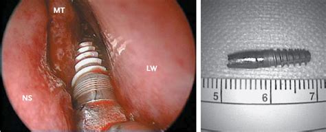 Dental Implant Ends Up In Woman S Sinus Live Science