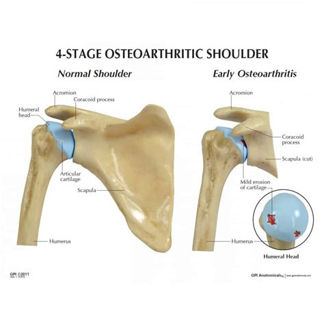 shoulder arthritis mississauga  oakville chiropractor
