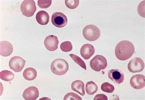 howell jolly bodies  sickle cell anemia pathology