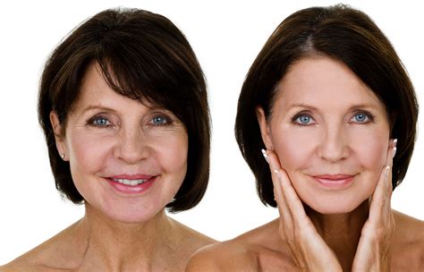 cost  facelift surgery benefits recovery results  expect