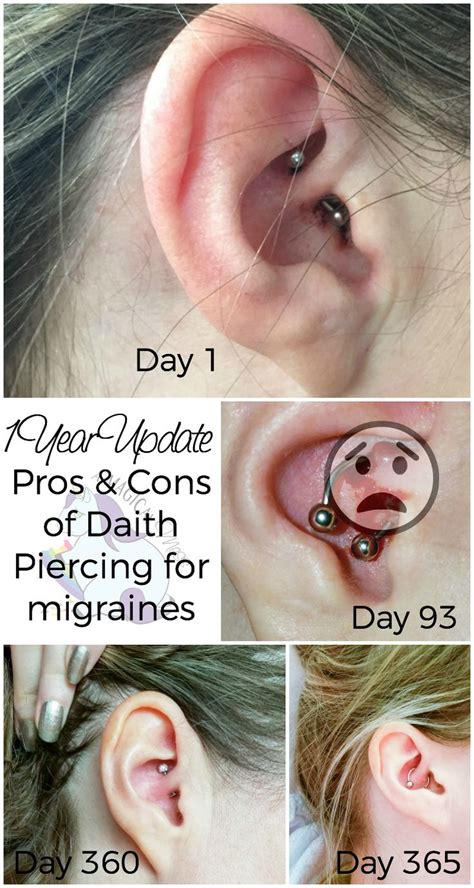 migraine piercing  year results  daith piercing