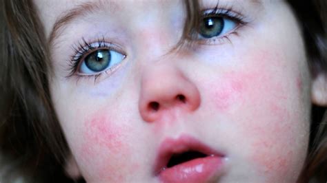 scarlet fever cases at 24 year high here s how to spot