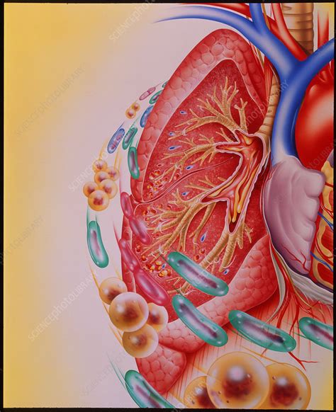 Bacterial Infection Of Lung Stock Image M240 0224 Science Photo