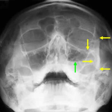 facial bone x rays