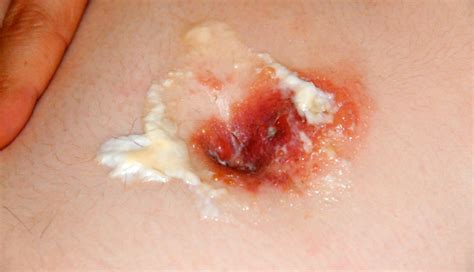 Learn Causes And Cures For Navel Or Belly Button Infection