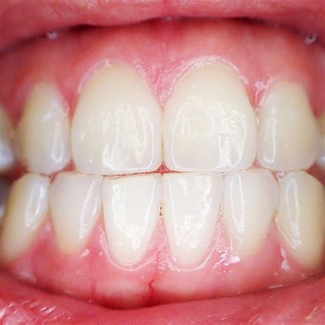 closer    teeth omni dental