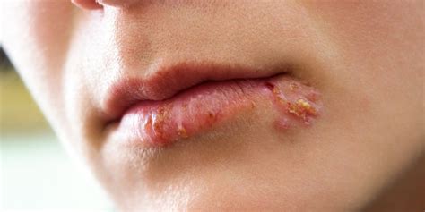 Herpes Im Mund Auslöser Und Behandlung Heilpraxis