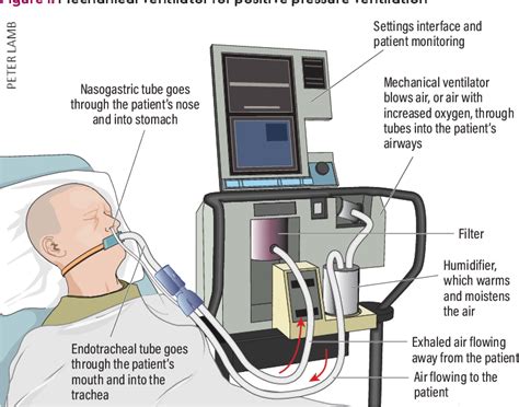 overview  mechanical ventilation   intensive care unit