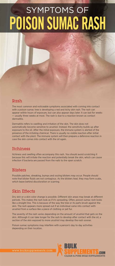 tablo read poison sumac rash characteristics  treatment