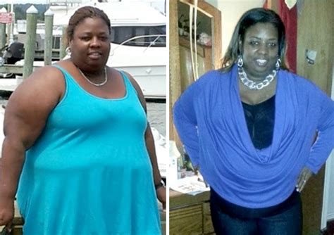Before And After Bariatric Surgery Three Inspirational