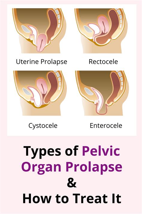 Pelvic Organ Prolapse Surgery Pelvic Floor Prolapse Prolapse