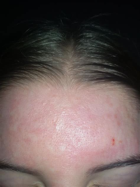 Blackheads And Scars On Forehead General Acne Discussion Forum
