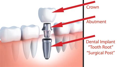 average cost   dental implant