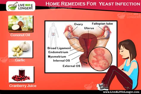 Top 3 Scientifically Proven Home Remedies For Yeast