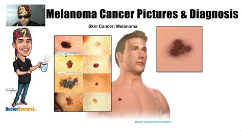 spotting melanoma cancer and symptoms with pictures