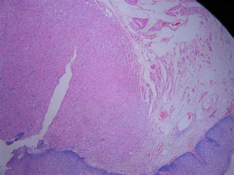 granular cell tumor esophagus histopathologyguru