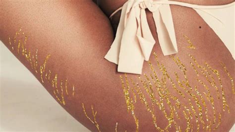 Woman Turns Stretch Marks Into Stunning Artwork With The