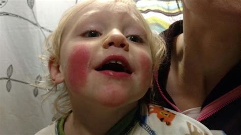 recurring red cheeks  toddler allergies  virus photo babycenter