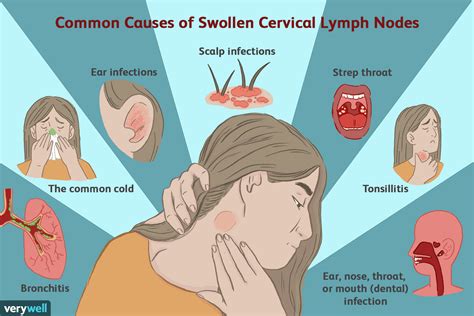 swollen lymph nodes neck strep throat