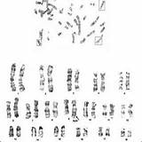 Cytogenetic Karyotype Xxy Chromosome Abnormality sketch template