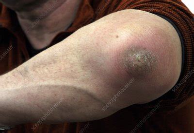 infected olecranon bursitis stock image  science photo