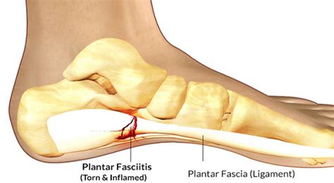 relieve fascia pain healthy food advice