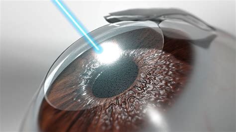 laser eye surgery improve vision techshim