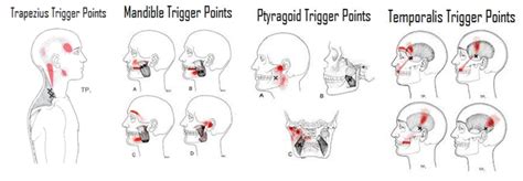 trigger point treatment of tmj moyer total wellness